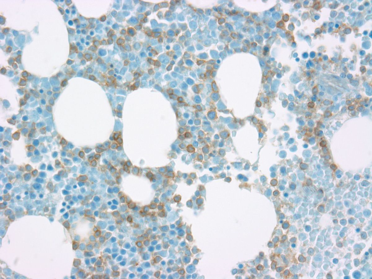 Bone marrow biopsy: CD99 positive B- lymphoblasts